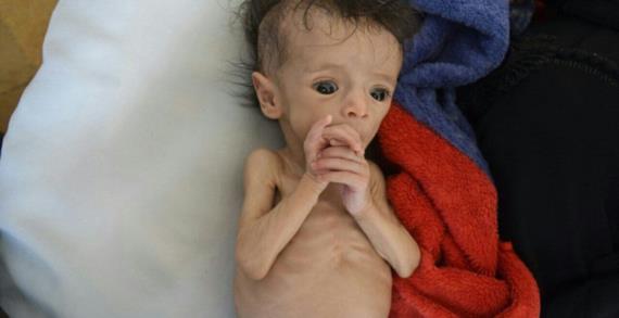 مباركة بريطانية لـ«التجويع»: «جرعة» جديدة تُسخط اليمنيين
